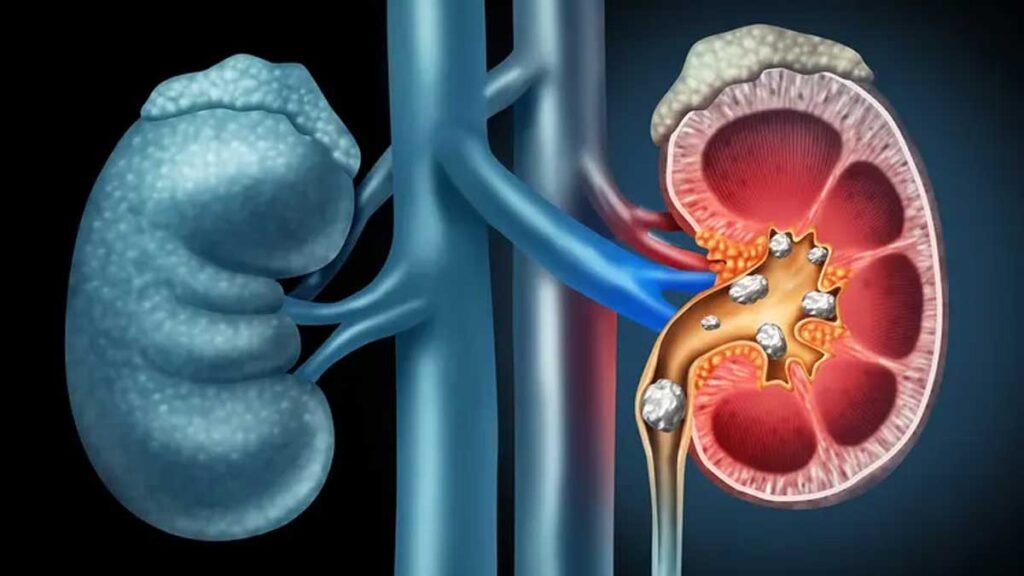 पथरी को हल्के में लेना पड़ सकता है भारी