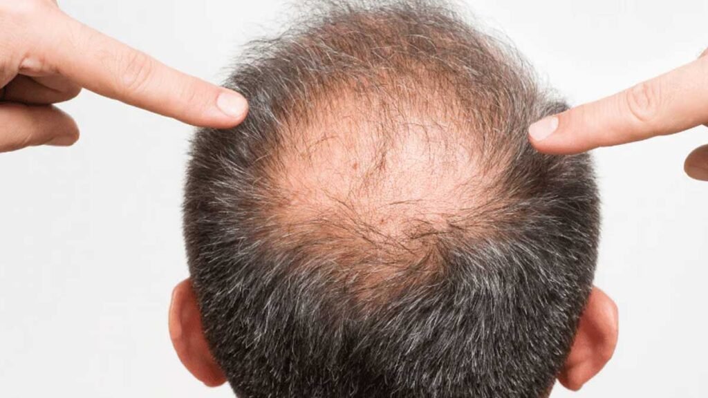 हार्मोनल बदलाव भी Hair Fall बढ़ा सकते हैं